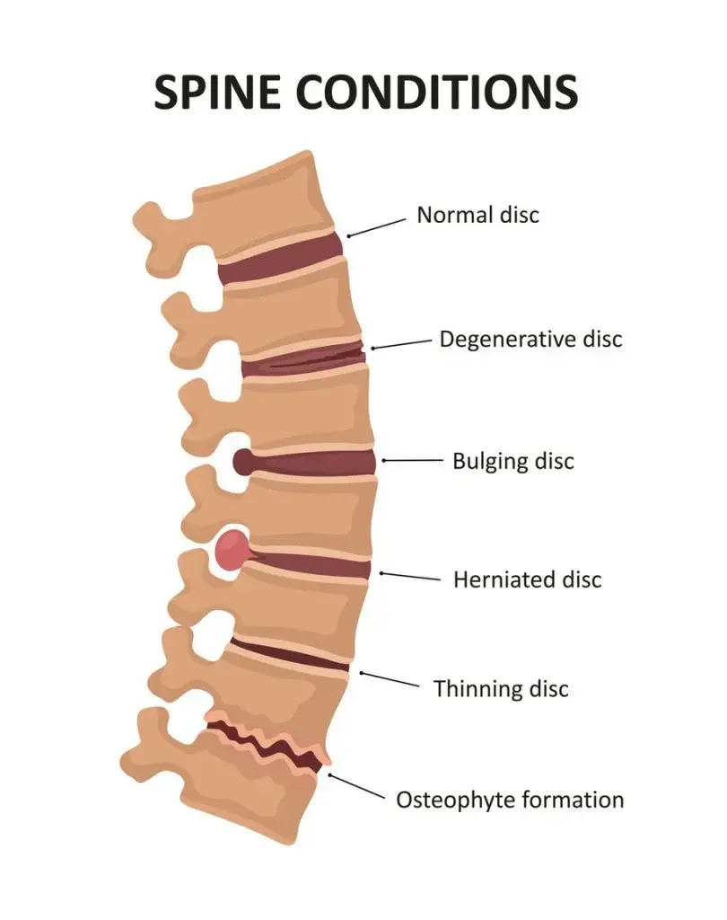 spine condition infographic