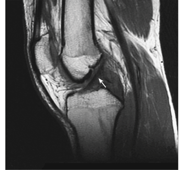 Figure 8: An MRI image of a normal knee.