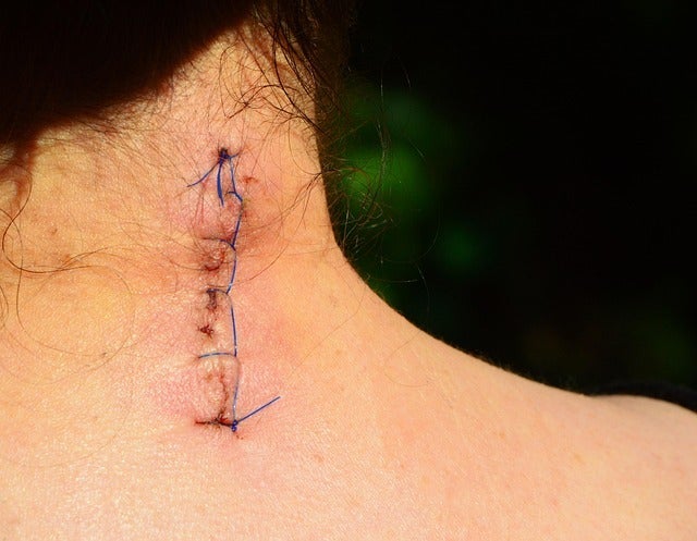 disfigurement damages in personal injury cases