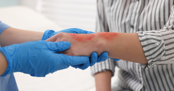burn injury