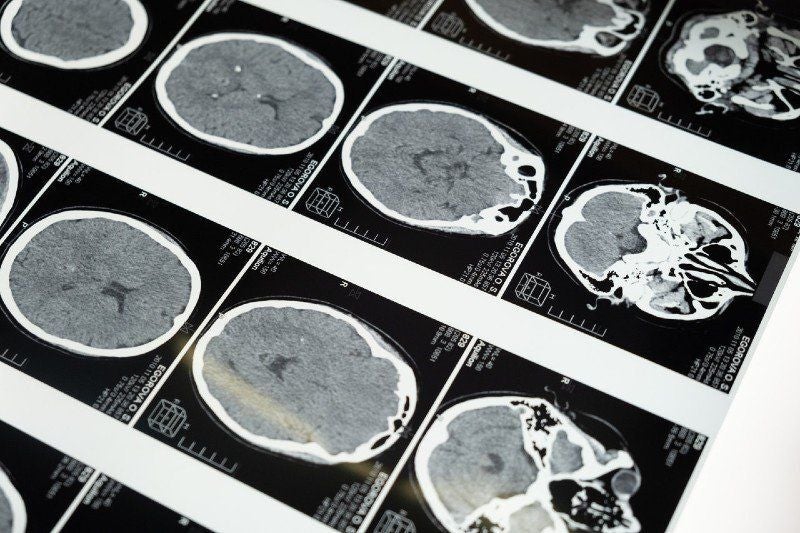 brain injury attorney in denver, co