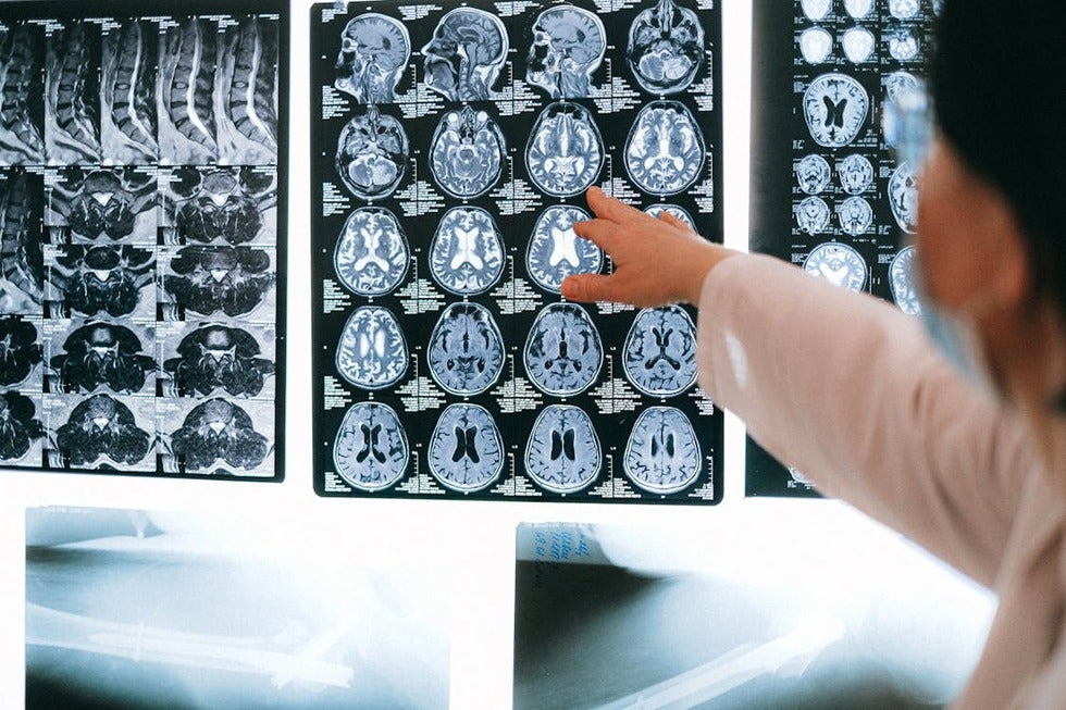 Long-term cognitive impacts of a severe TBI