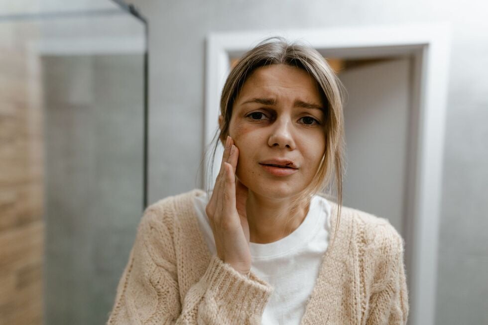 Woman with a bruised face from domestic violence in Indiana